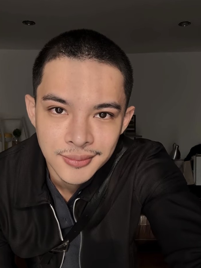 Rey Mbayang: Perjuangannya Menghadapi Autoimun Psoriasis